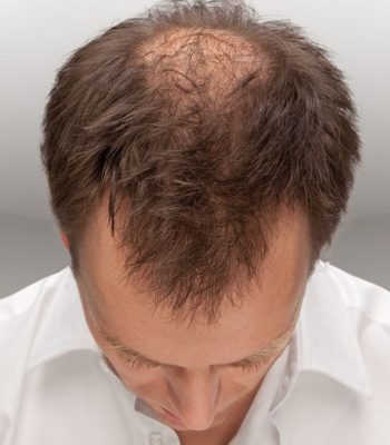 male-pattern-hair-loss-scaled